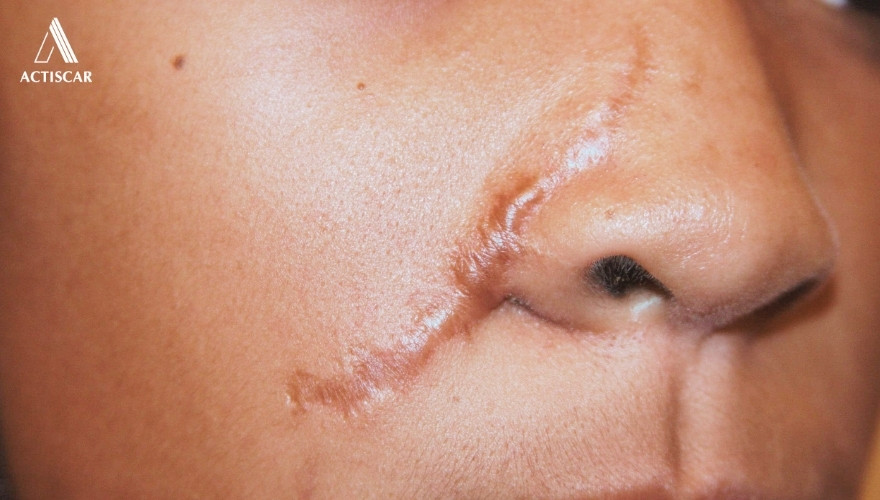 Sẹo lồi trên mặt là gì?