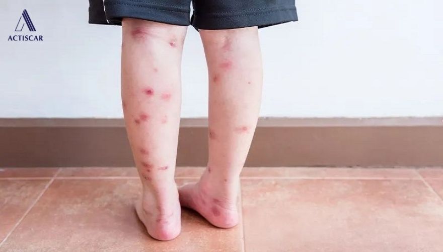 Sẹo thâm ở chân khó điều trị và dễ tồn tại lâu dài
