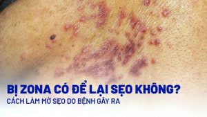 Sử dụng kem trị sẹo sau Zona để xử lý sẹo xấu