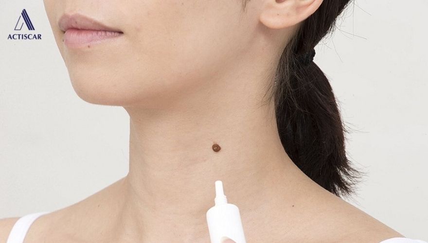 Sử dụng kem trị sẹo thâm sau khi tẩy nốt ruồi