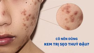 Sử dụng kem trị sẹo thủy đậu có hiệu quả?