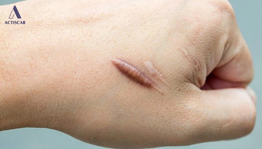 Thế nào là sẹo lồi bị thâm