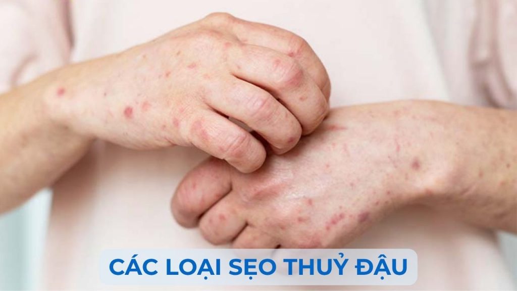 Thuỷ đậu có thể để lại sẹo xấu nếu không được chăm sóc đúng cách