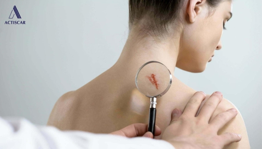 Trị sẹo lồi mới hình thành từ sớm mang đến nhiều lợi ích