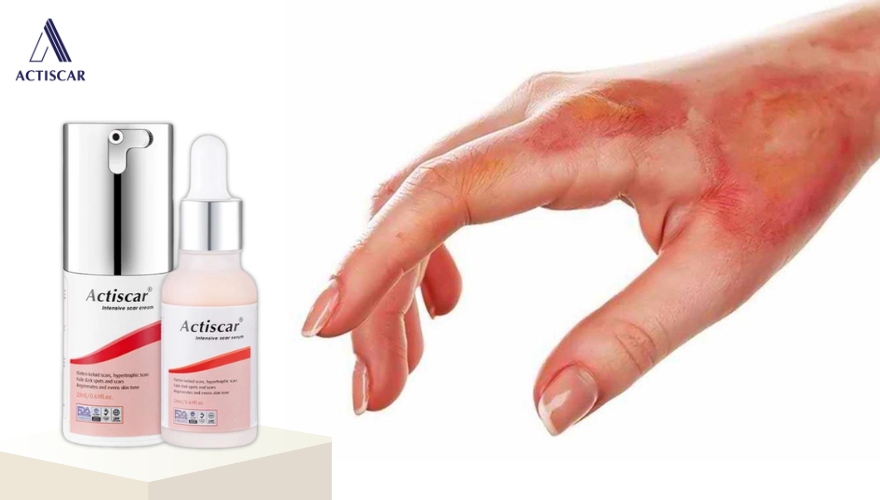 Xoá mờ sẹo lồi do bỏng tại nhà với bộ đôi Actiscar