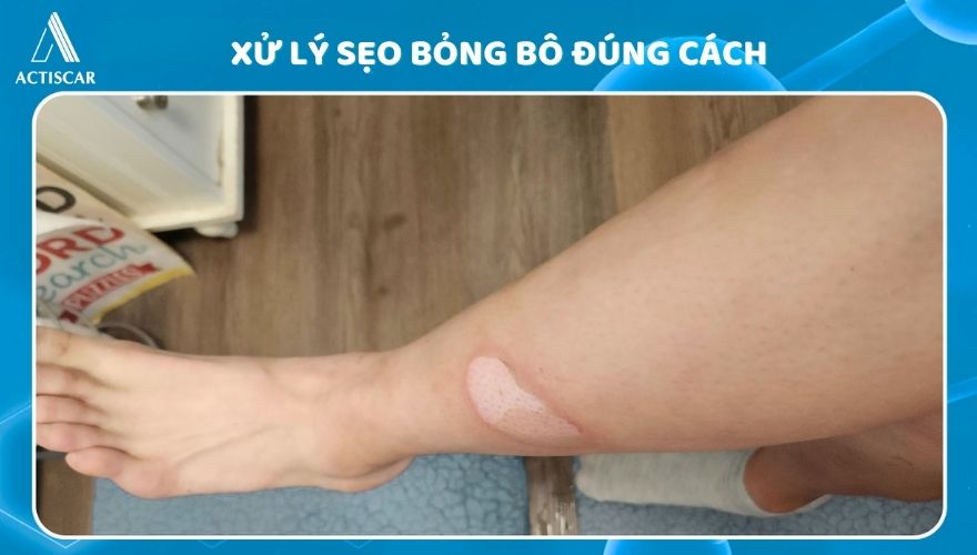 Xử lý đúng cách giúp vết bỏng bô không để lại sẹo