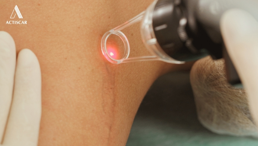 Xử lý sẹo lồi bằng cách sử dụng liệu pháp laser
