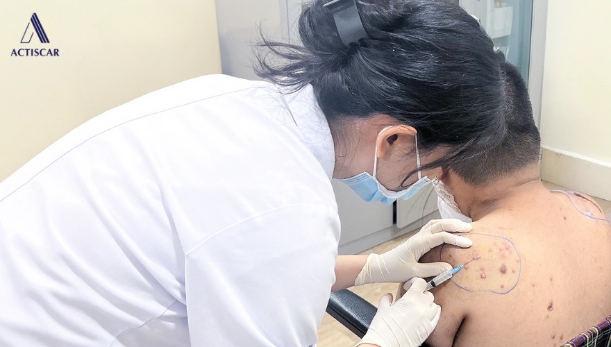 Xử lý sẹo lồi do mụn bằng phương pháp y khoa