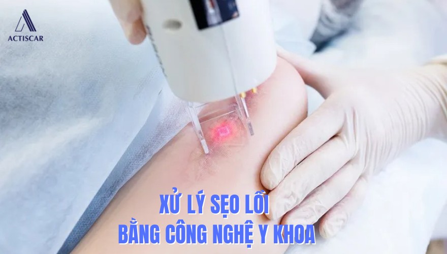 Xử lý sẹo lồi tự mọc bằng công nghệ y khoa