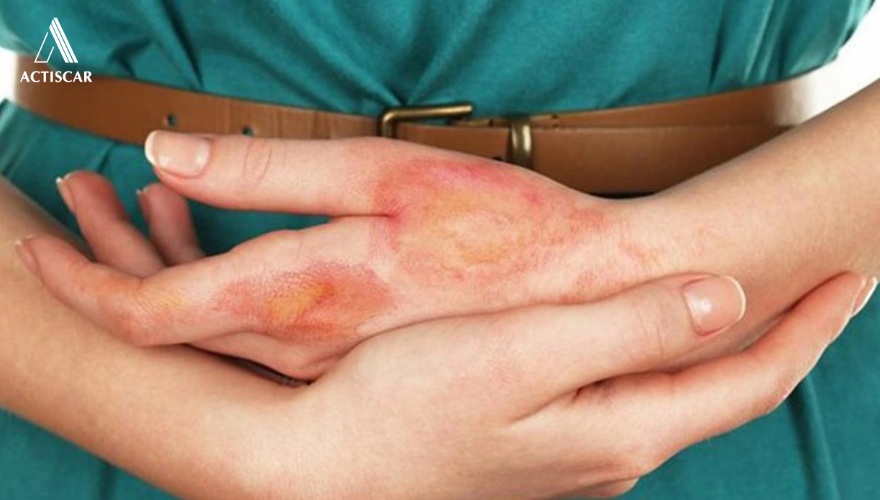 Xử lý vết bỏng sai cách làm tăng nguy cơ bị sẹo lồi do bỏng