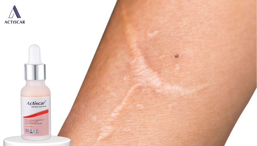 Xử lý xoá mờ sẹo lồi với Serum sẹo lồi