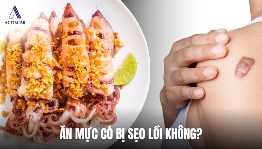Ăn mực có bị sẹo lồi không?