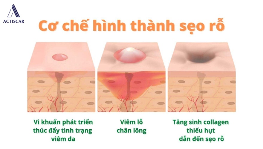 Bản chất và cơ chế hình thành sẹo rỗ