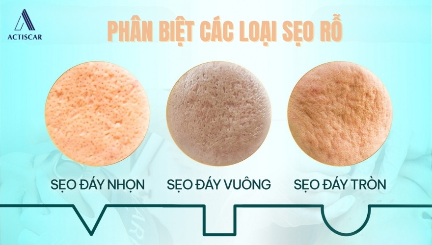 Các loại sẹo rỗ thường gặp