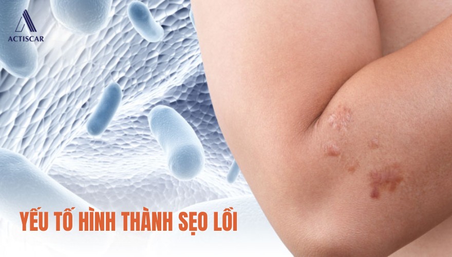 Các yếu tố quyết định việc hình thành nên sẹo lồi