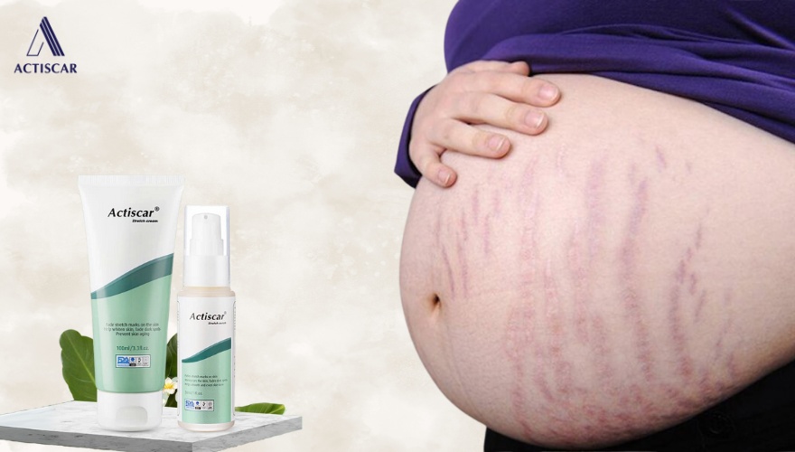 Cách cải thiện rạn da đỏ tại nhà với bộ đôi Actiscar