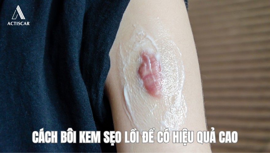 Cách sử dụng kem bôi sẹo lồi để có hiệu quả