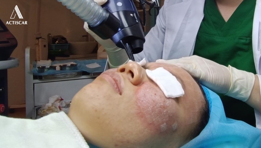 Cải thiện sẹo rỗ bằng các phương pháp can thiệp chuyên sâu
