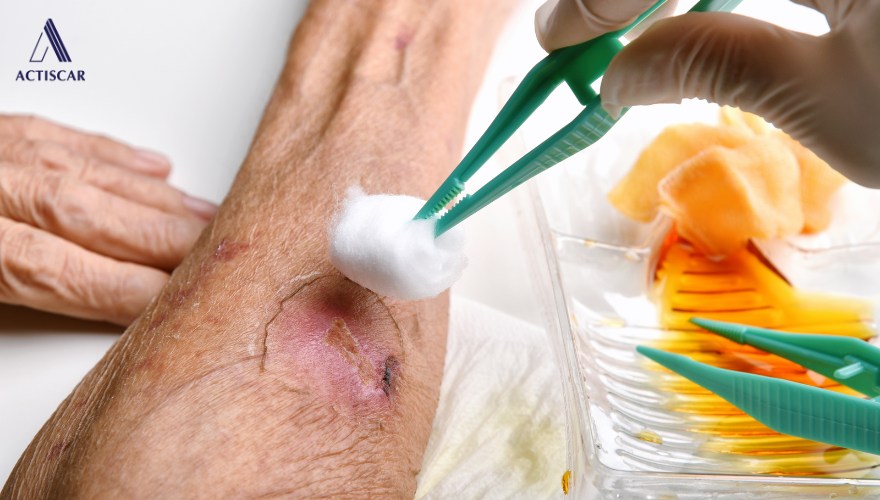 Chăm sóc vết thương đúng cách giúp hạn chế hình thành sẹo lồi