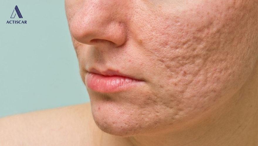 Đặc điểm của sẹo lõm lâu năm