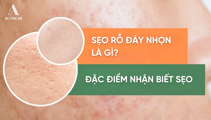 Đặc điểm nhận biết sẹo rỗ đáy nhọn