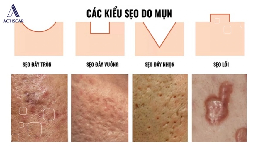 Đặc điểm và phân loại của các loại sẹo rỗ