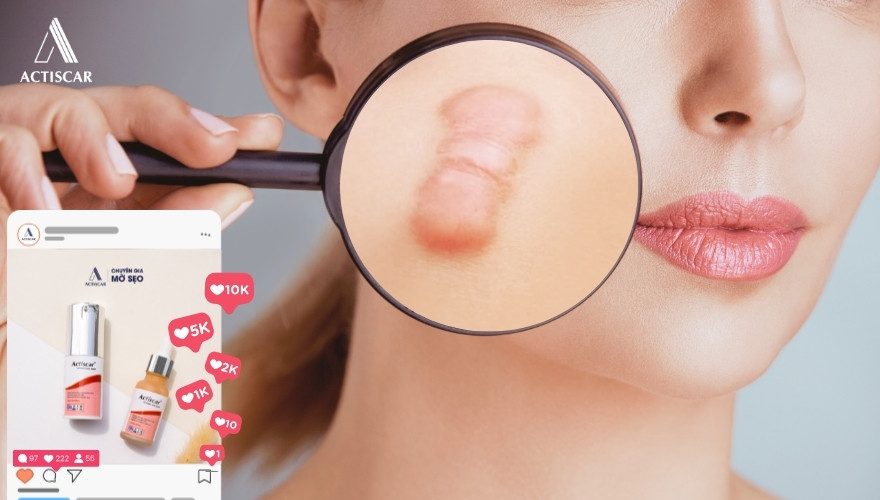 Giải pháp chăm sóc ăn toàn cho da bị sẹo lồi