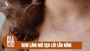 Giới thiệu kem trị sẹo lồi lâu năm