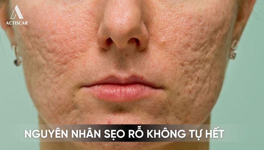Lý do khiến sẹo rỗ không thê tự hết theo thời gian