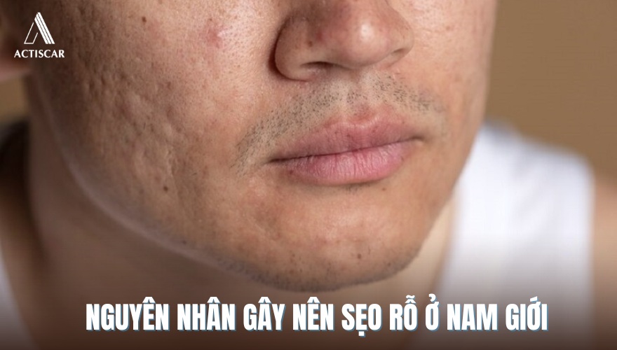 Nguyên nhân gây nên sẹo rỗ ở nam giới