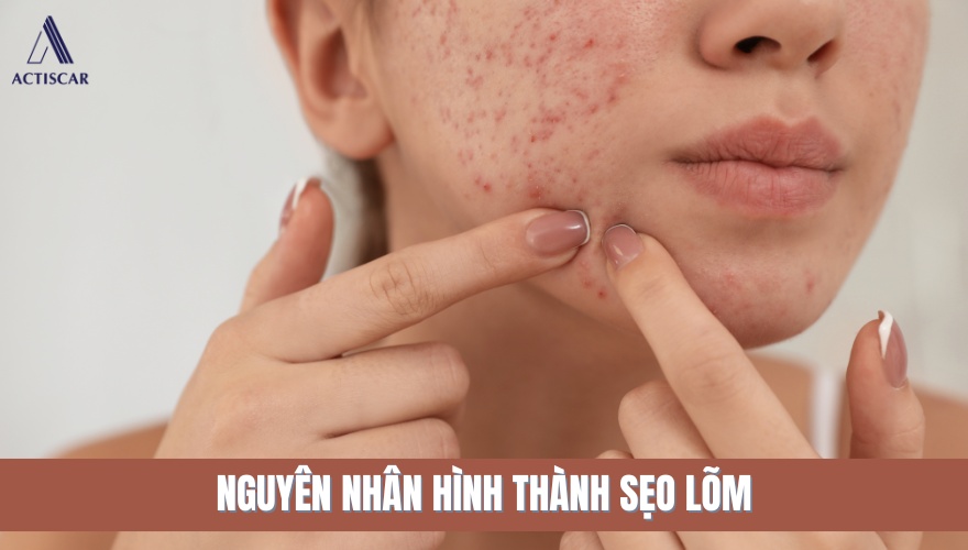 Nguyên nhân hình thành sẹo lõm là gì?