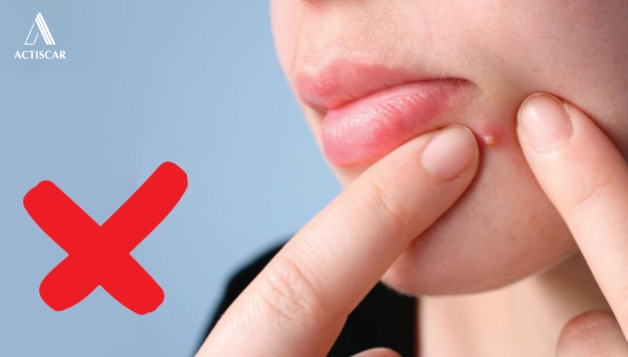 Nguyên nhân hình thành sẹo rỗ đáy nhọn