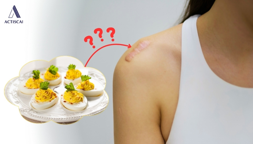 Nguyên nhân khiến mọi người nghĩ ăn trứng gây sẹo