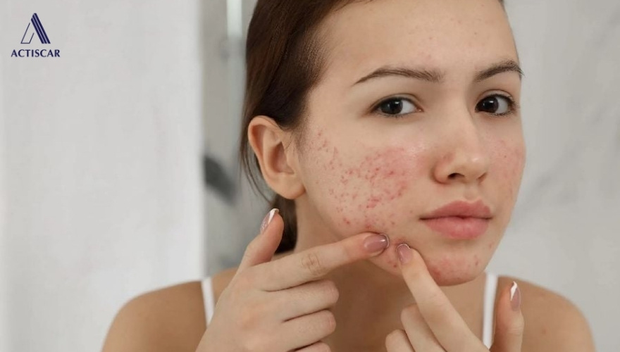Nguyên nhân xuất hiện sẹo rỗ