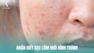 Nhận diện sẹo lõm mới hình thành
