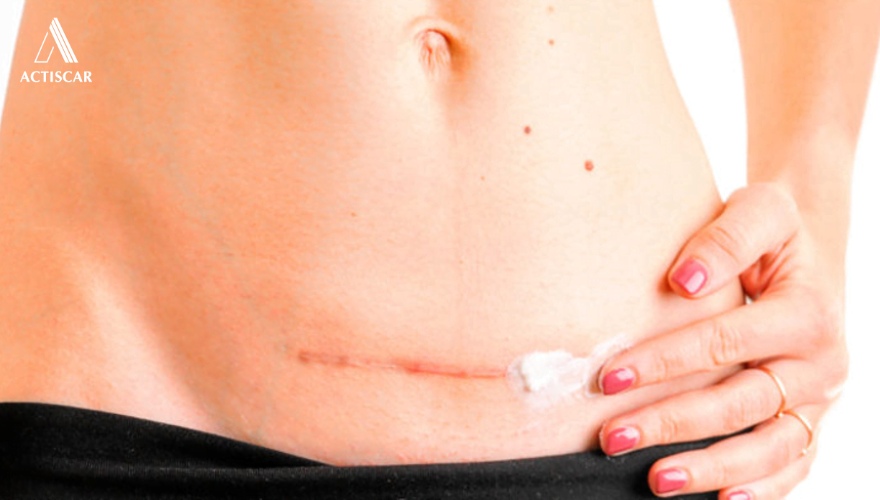 Những lưu ý khi chăm sóc sẹo sau sinh mổ