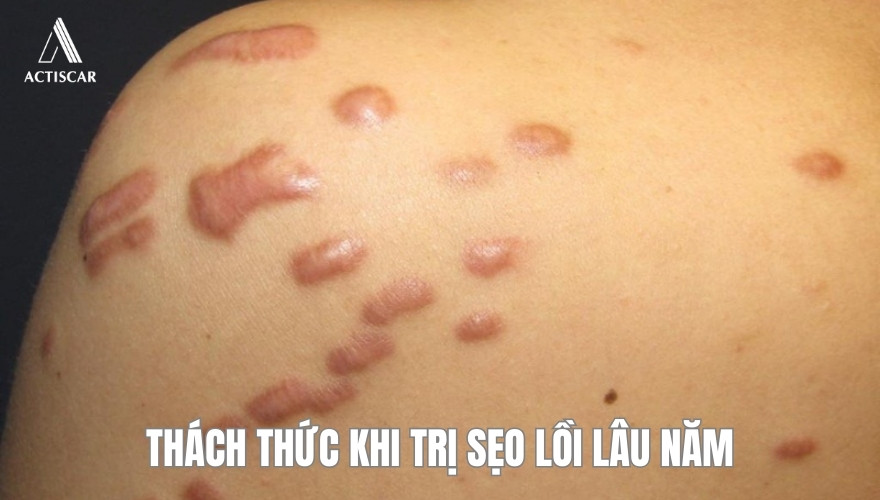 Những thách thức khi trị sẹo lồi lâu năm