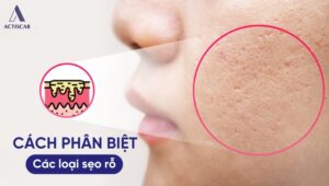 Phân biệt các loại sẹo rỗ