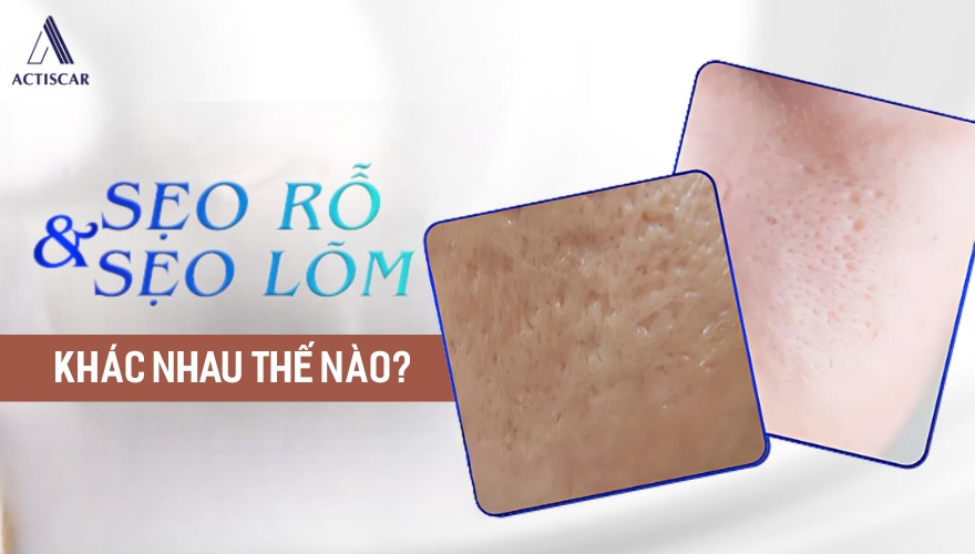 Phân biệt giữa sẹo lõm và sẹo rỗ: điểm giống và khác