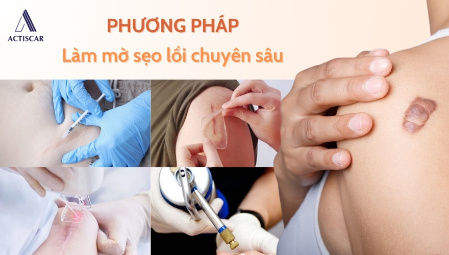 Phương pháp can thiệp lâm sàng để làm mờ sẹo lồi