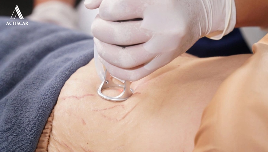 Phương pháp điều trị rạn chuyên sâu