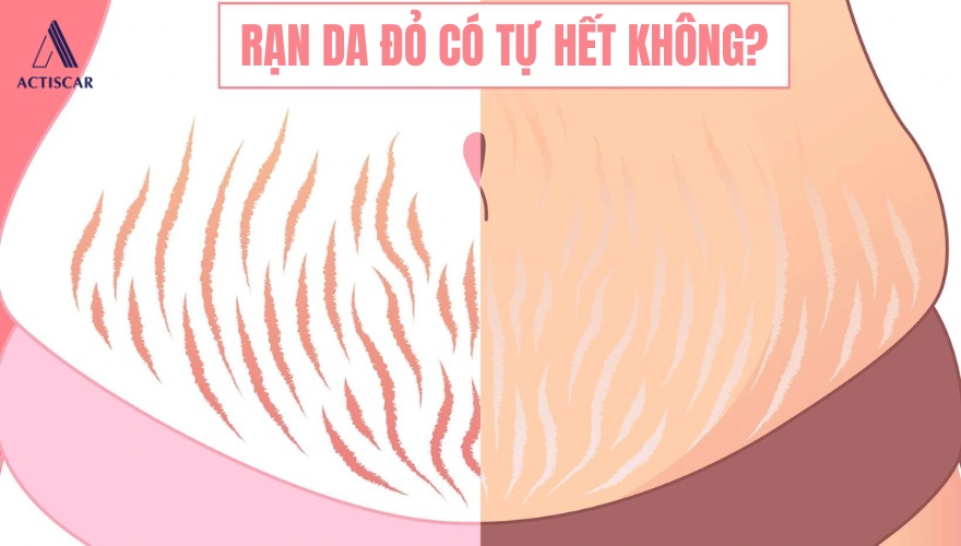 Rạn da đỏ có thể tự hết theo thời gian hay không