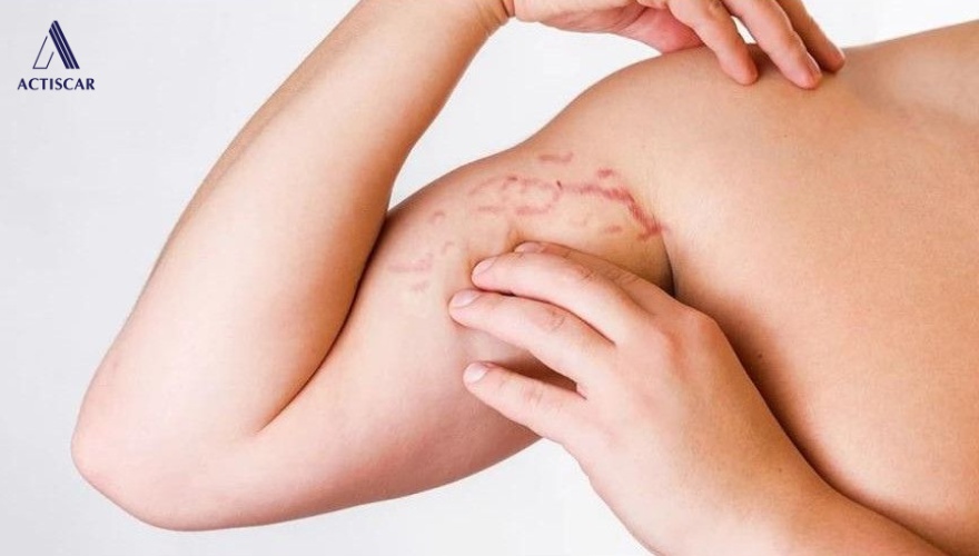 Rạn da đỏ là gì? Nguyên nhân gây rạn