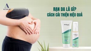 Rạn da là gì? Phương pháp cải thiện rạn