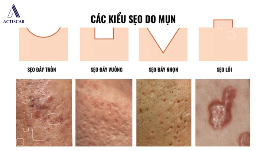 Sẹo lõm là gì, các kiểu sẹo lõm thường gặp