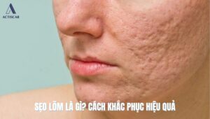 Sẹo lõm là gì? Đặc điểm sẹo lõm