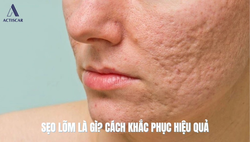 Sẹo lõm là gì? Đặc diểdm sẹo lõm