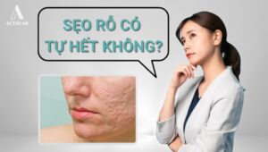 Sẹo rỗ có tự hết không?