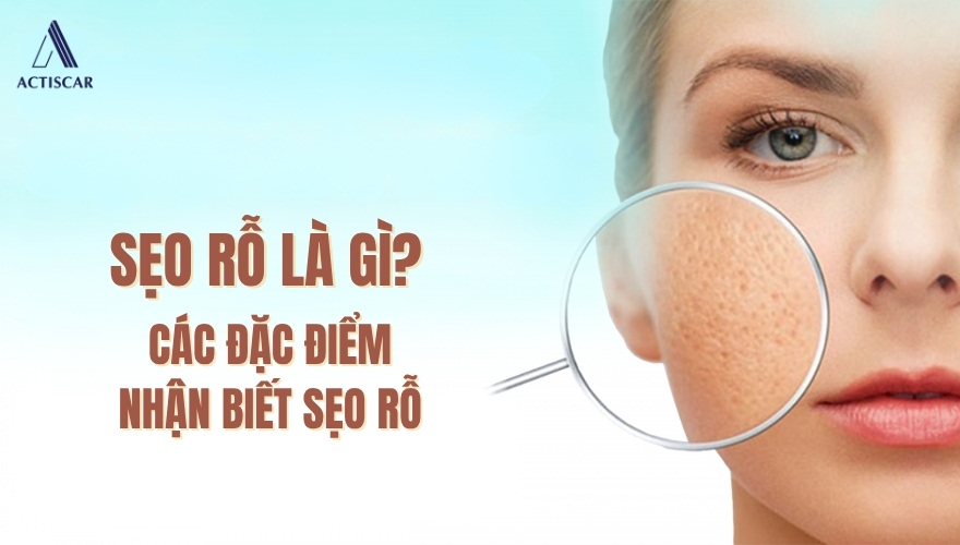 Sẹo rỗ là gì, các đặc điểm của sẹo rỗ