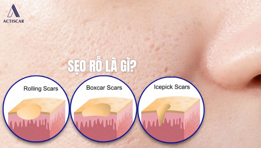 Sẹo rỗ là gì? Các loại sẹo rỗ thường gặp